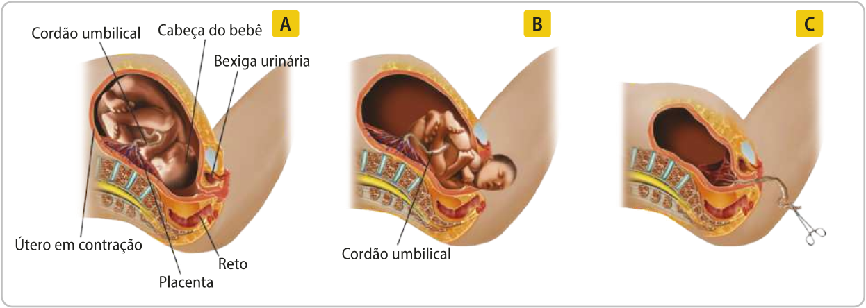 Composição com três esquemas representando os momentos do parto. O abdômen inferior da mulher está em corte sagital, as seguintes estruturas: cordão umbilical, útero em contração, placenta, reto e bexiga urinária. A. O bebê está dentro do útero com a cabeça voltada para a vagina. O cordão umbilical conecta o bebê à placenta. B. O bebê começa a sair pela vagina. A cabeça é a primeira parte a sair. C. O útero está vazio, apenas com a placenta dentro, o cordão umbilical foi cortado e está para fora do corpo da mulher, mas ainda conectado à placenta.