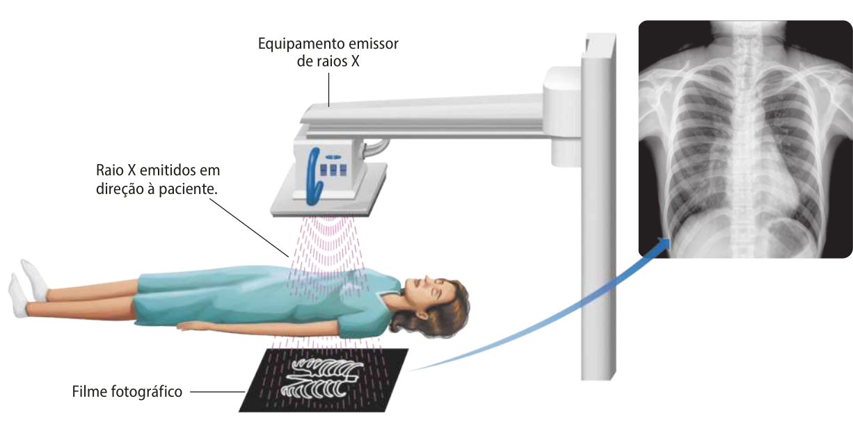 Esquema representando um exame de radiografia. Uma mulher está deitada abaixo de um equipamento emissor de raios X. Os raios X são emitidos em direção à paciente. Abaixo da paciente há um filme fotográfico que imprime a imagem de sua caixa torácica. Ao lado está uma imagem real feita através de raio X.