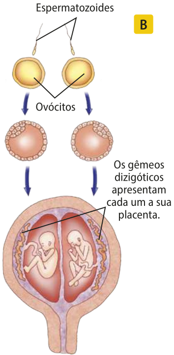 Esquema B. Dois espermatozoides fecundam dois ovócitos. Cada ovócito se desenvolve em um zigoto com uma massa celular cada um. Cada zigoto se desenvolve em um feto, dando origem a gêmeos dizigóticos, cada um com a sua placenta dentro do útero.