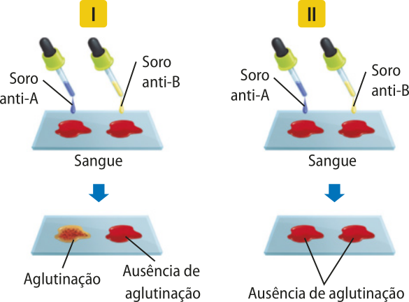 Esquema representando dois experimentos. 1. Placa de vidro com duas gotas de sangue. uma gota de soro anti-A é colocada sobre a primeira gota de sangue. Uma gota de soro anti-B é colocada sobre a segunda gota de sangue. Passado o tempo, a primeira gota de sangue sofre uma leve descoloração e apresentou aglutinação. A segunda gota permaneceu igual, sem aglutinação. 2. Igual ao primeiro experimento. Porém, passado o tempo, as duas gotas de sangue permanecem iguais, sem aglutinação.