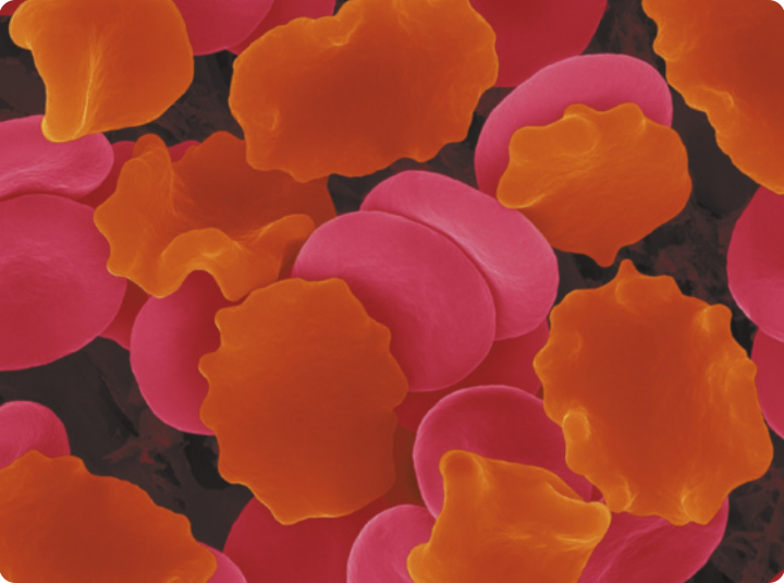 Imagem microscópica de diversas hemácias. Aproximadamente metade tem o formato de disco côncavo e metade está disforme, com a superfície ondulada.