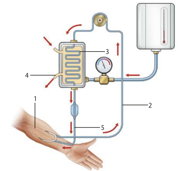 Esquema representando o processo de hemodiálise. Estão representados o braço do paciente (1), o cateter que conduz o sangue do paciente (2), o filtro (3), a solução de água ultrapura (4) e o cateter que leva de volta o sangue ao paciente (5).