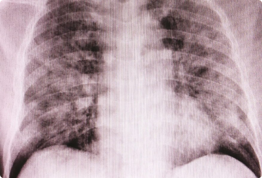 Fotografia de uma radiografia do tórax de uma pessoa, mostrando as costelas.