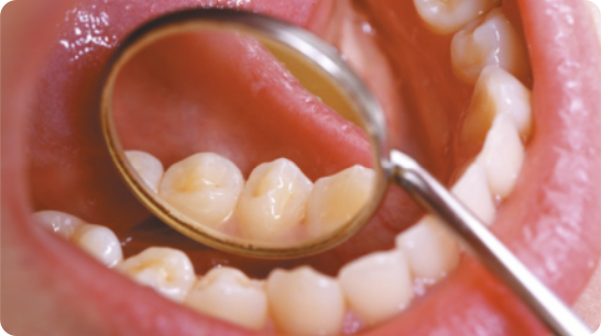 Fotografia de uma boca aberta, aparecendo os dentes, dentro da boca uma ferramenta de dentista, com um espelho redondo na ponta, onde os dentes estão refletidos.