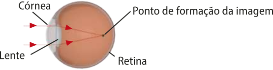 Representação das imagens que se formam no olho do funcionário 'A'. Na imagem o globo ocular, com a córnea e a lente na parte da frente e a retina ao fundo, o ponto de formação da imagem é anterior a retina.