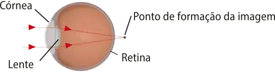 Representação das imagens que se formam no olho do funcionário 'B'. Na imagem o globo ocular, com a córnea e a lente na parte da frente e a retina ao fundo, o ponto de formação da imagem é posterior a retina.