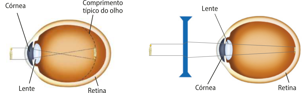 Representação de um bulbo de olho com miopia e a correção com o uso de lente convergente. Na imagem1: o globo ocular com a córnea e a lente na parte da frente a esquerda e a retina na parte de trás, a direita podemos notar que a imagem formada na retina é anterior a normal, a imagem mostra que o comprimento do olho com miopia é maior. Na imagem 2: uma lente é colocada na frente do olho corrigindo o ângulo da retina.