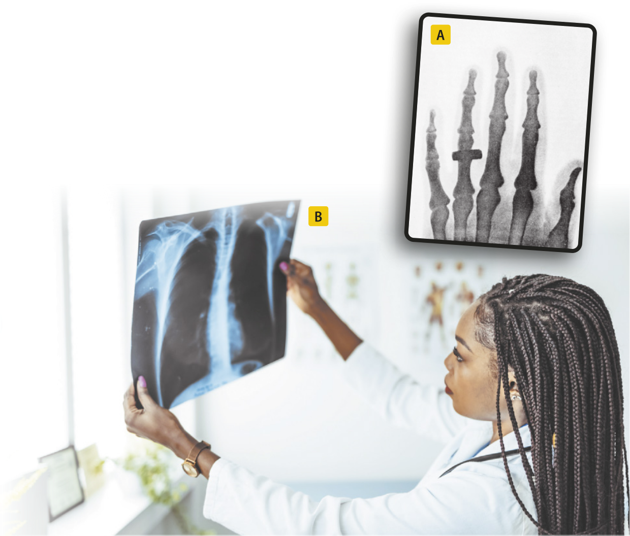 Composição com duas imagens. A: imagem dos ossos do interior da mão de uma pessoa. É possível observar um anel no dedo anelar. B: imagem de uma médica observando imagem de radiografia do tórax de uma pessoa.