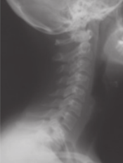Imagem de radiografia do pescoço de uma pessoa.