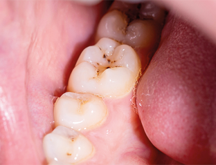 Fotografia do interior de uma boca, com os dentes inferiores molares de um dos lados. Há manchas escuras na superfície dos dentes.