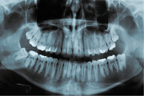 Fotografia de uma radiografia panorâmica evidenciando dentes e ossos de uma pessoa. Os ossos estão com coloração mais clara e o fundo é escuro.