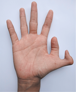 Fotografia de uma mão com seis dedos. A palma está voltada para frente, e ao lado do polegar, há um dedo curto com formato curvo.