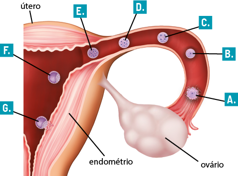Ilustração em corte de parte das estruturas internas do sistema genital feminino. É composto por: útero, parte de cima e externa; endométrio, diversas camadas no interior do útero; ovário, estrutura ovalado ligado ao útero e a uma estrutura parecida com tubo. Dentro do tubo, partindo próximo do ovário até o útero há uma sequência: marcada pela letra A tem uma estrutura circular com a camada externa bem irregular com bastante fios; marcada pela letra B tem a estrutura circular com uma círculo dentro; marcada pela letra C tem a estrutura circular com outras 4 circulares dentro; marcada pela letra D tem a estrutura circular com outras 7 circulares dentro; marcada pela letra E tem a estrutura circular com muitas outras estruturas circulares dentro; marcada pela letra F tem a estrutura circular com o pedaço mais escuro na esquerda e mais clara na direita, está próximo do endométrio; marcado pela letra G tem a estrutura quase circular com o pedaço mais escuro na esquerda e a parte mais clara está grudada no endométrio.