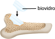 Ilustração de um osso com uma camada que possui várias manchas pequenas. Um pouco acima há um material de vidro, indicado como biovidro e uma seta apontando para ele em contato com a camada com manchas.
