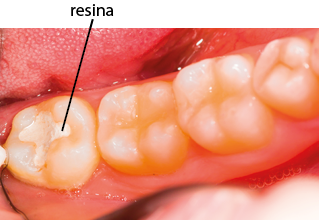 Fotografia de quatro dentes em uma boca. No primeiro dente há uma região mais clara no centro indicado por resina.