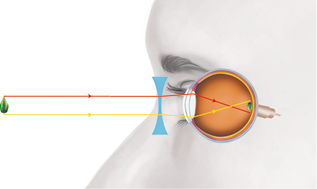 Ilustração lateral de um rosto, na região dos olhos, com o globo ocular aparente e uma folha na frente. Há uma indicação de segmentos de reta com setas que saem de uma folha e vão até a área interna do olho. No fundo do olho há uma folha menor e ao contrário. Há um segmento vermelho que parte da área superior da folha externa, horizontalmente até a parte superior da córnea e vai até a parte inferior da folha menor. Um segmento amarelo parte da área inferior da folha externa, horizontalmente até a parte inferior da córnea e vai até a parte superior da folha menor. Logo em frente ao olho, entre ele e a folha há uma lente esférica divergente, por onde passam os segmentos.