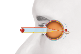 Ilustração lateral do rosto, na região dos olhos, com o globo ocular aparente e uma maçã na frente. Há uma indicação de segmentos de reta com setas que saem de uma maçã e passam da área interna do olho. Atrás do fundo do olho há uma maçã menor e ao contrário. Um segmento vermelho parte da área superior da maçã externa, horizontalmente até a parte superior da córnea e vai até a parte inferior da maçã menor. Um segmento amarelo parte da área inferior da maçã externa, horizontalmente até a parte inferior da córnea e vai até a parte superior da maçã menor.