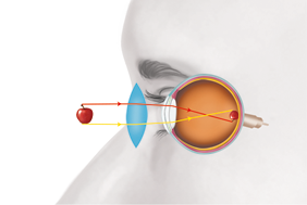 Ilustração lateral do rosto, na região dos olhos, com o globo ocular aparente e uma maçã perto, na frente. Há a indicação de segmentos de reta com setas que saem da maçã e vão até a área interna do olho. No fundo do olho há uma maçã menor e ao contrário. Um segmento vermelho parte da área superior da maçã externa, horizontalmente até a parte superior da córnea e vai até a parte inferior da maçã menor. Um segmento amarelo parte da área inferior da maçã externa, horizontalmente até a parte inferior da córnea e vai até a parte superior da maçã menor. Logo em frente ao olho, entre ele e a maçã há uma lente esférica convergente, por onde passam os segmentos.