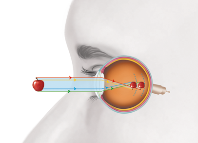 Ilustração lateral do rosto, na região dos olhos, com o globo ocular aparente e uma maçã na frente. Perto do fundo do olho há duas maçãs menores e ao contrário, uma na frente da outra. Um segmento vermelho parte da área superior da maçã externa, horizontalmente até a parte superior da córnea e vai até a parte inferior da maçã menor e de trás. Um segmento amarelo parte da área superior da maça externa, horizontalmente até a parte superior da córnea e depois segue diagonalmente até a parte inferior da maçã menor da frente. O segmento verde parte da área inferior da maçã externa, horizontalmente até a parte inferior da córnea e vai até a parte superior da maçã menor de trás. O segmento azul parte da área inferior da maça externa, horizontalmente até a parte inferior da córnea e depois segue diagonalmente até a parte superior da maçã menor da frente.