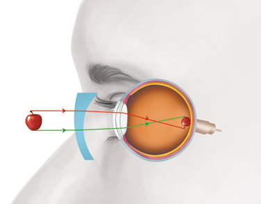 Ilustração lateral do rosto, na região dos olhos, com o globo ocular aparente e uma maçã perto, na frente. Há uma indicação de segmentos de reta com setas que saem da maçã e vão até a área interna do olho. No fundo do olho há uma maçã menor e ao contrário. Um segmento vermelho parte da área superior da maçã externa, horizontalmente até a parte superior da córnea e vai até a parte inferior da maçã menor. Um segmento verde parte da área inferior da maçã externa, horizontalmente até a parte inferior da córnea e vai até a parte superior da maçã menor. Logo em frente ao olho, entre ele e a maçã há uma lente cilíndrica, por onde passam os segmentos.